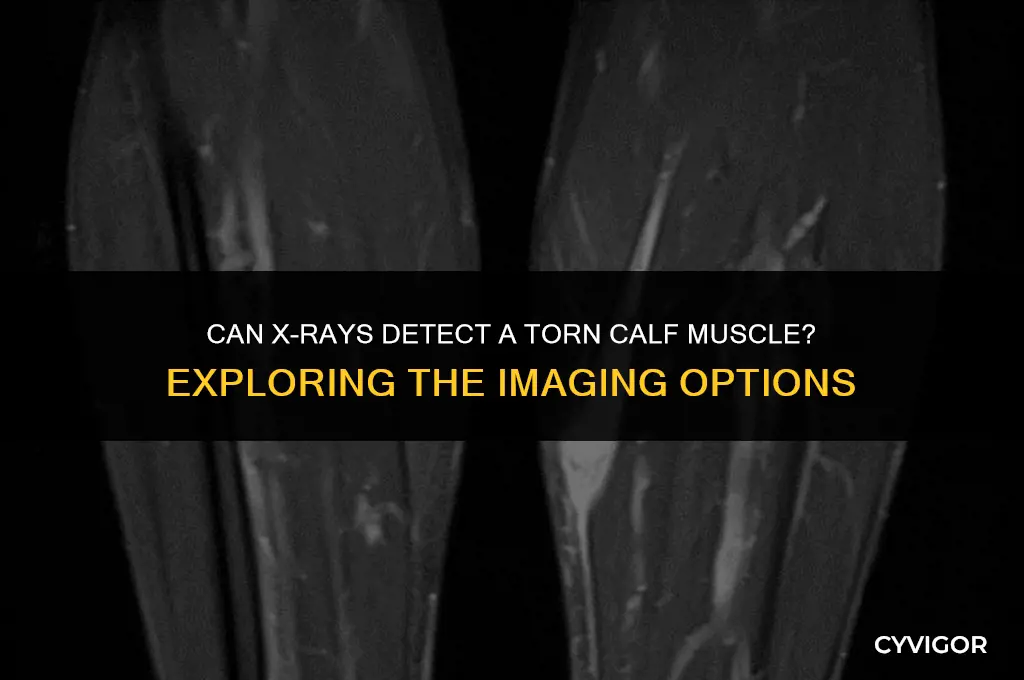 do xrays confirm a torn calf muscle