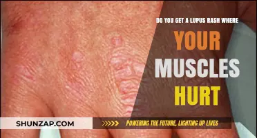 Understanding Lupus: The Connection Between Rashes and Muscle Pain