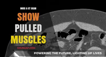 Can CT Scans Detect Pulled Muscles? Unraveling the Diagnostic Mystery