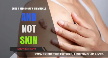 Keloid Growth: Understanding Its Relationship with Muscle and Skin