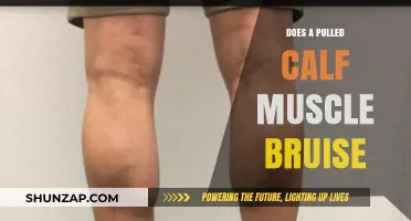 Can a Pulled Calf Muscle Cause Bruising? Facts and Insights