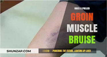 Pulled Groin Muscle: Understanding Bruising and Recovery Process