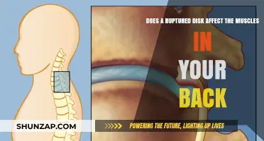 Exploring the Impact of a Ruptured Disk on Back Muscles