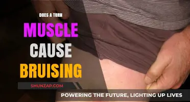 How Torn Muscles and Bruising Are Related