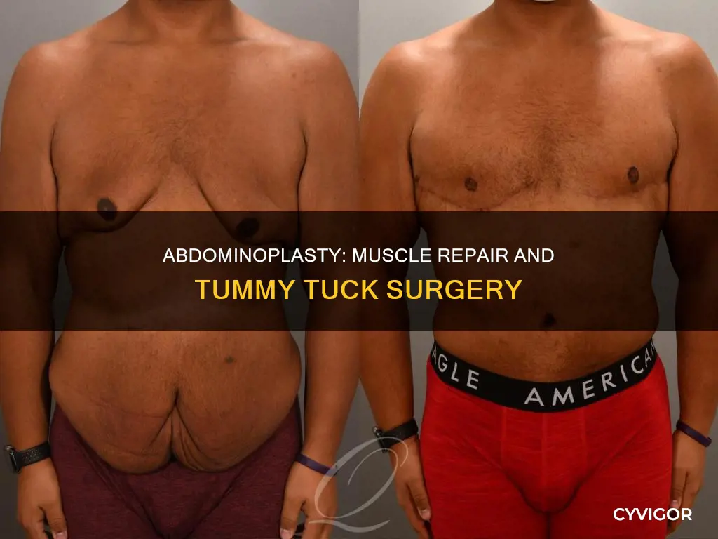 does abdominoplasty include muscle repair