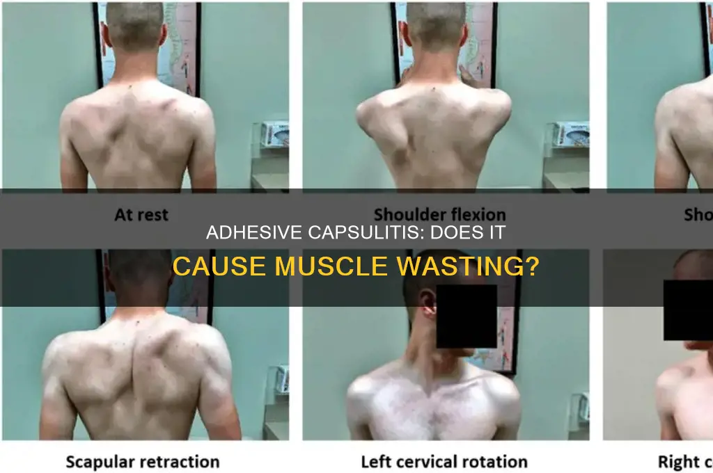 does adhesive capsulitis cause muscle wasting