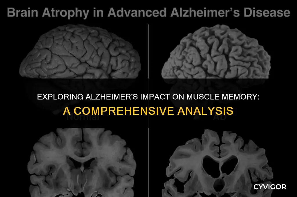 does alzheimer