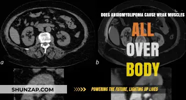 Angiomyolipoma: Weak Muscles and Body Connection