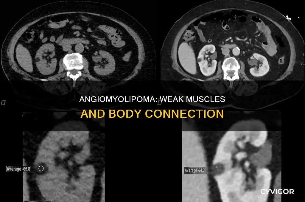 does angiomyolipoma cause weak muscles all over body