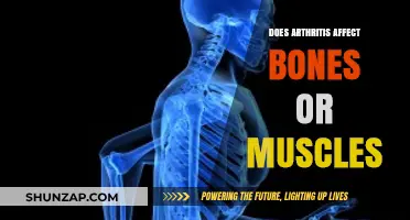 Unraveling the Mystery: Arthritis' Impact on Bones vs. Muscles