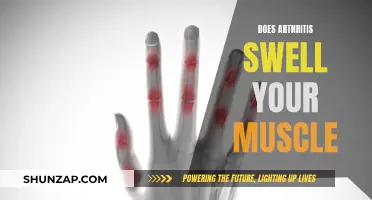 Arthritic Swelling: Muscle or Joint Issue?