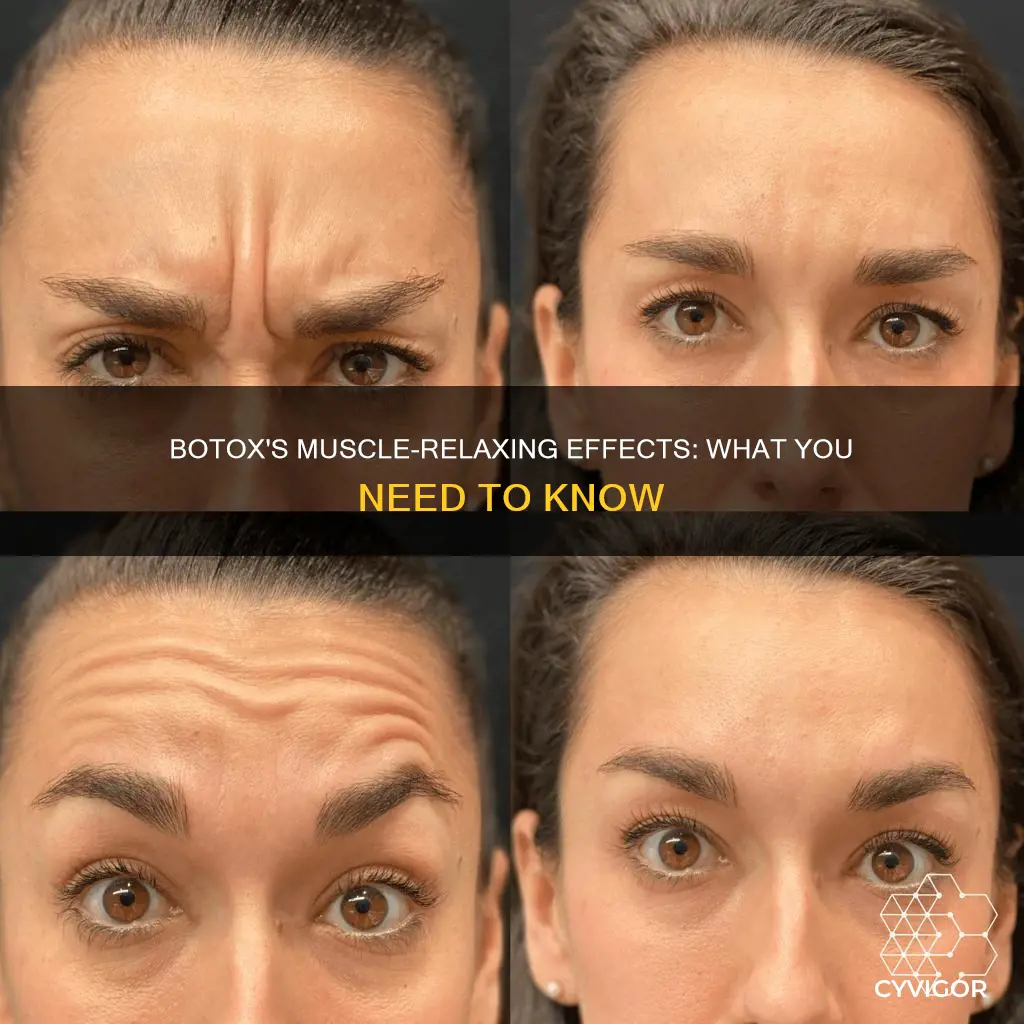 does botox loosen muscles