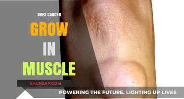 Can Cancer Develop in Muscles? Understanding Soft Tissue Sarcomas