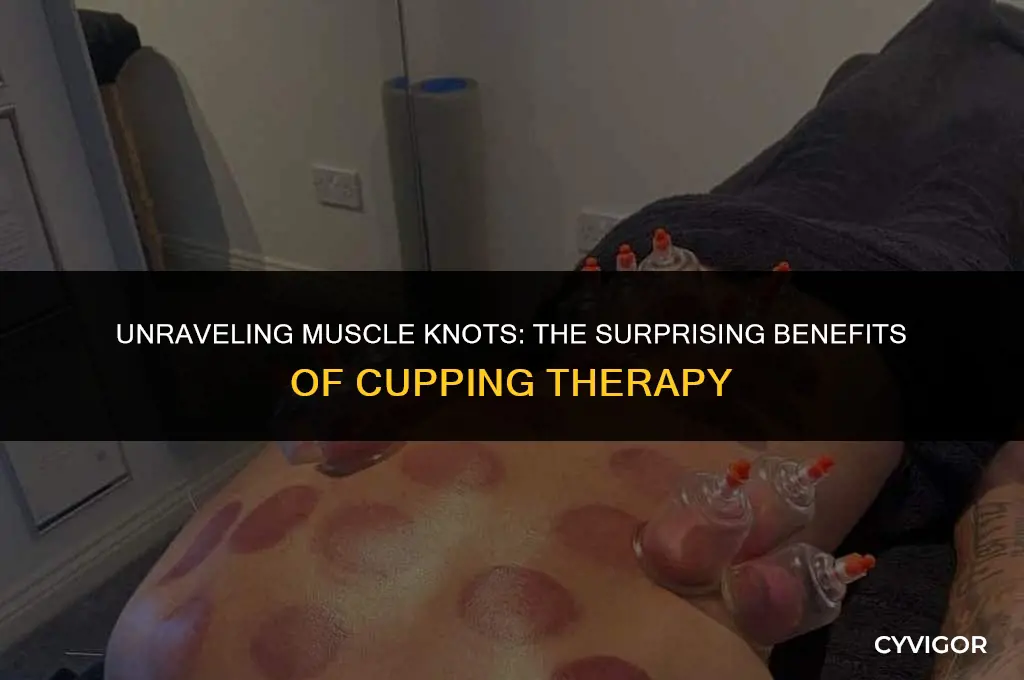 does cupping get rid of muscle knots