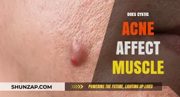 Unveiling the Truth: Cystic Acne's Impact on Muscle Health