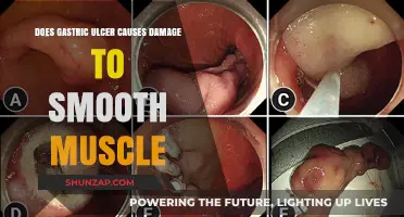 Gastric Ulcers: Smooth Muscle Damage and You