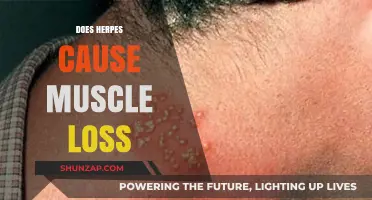 Herpes and Muscle Loss: Is There a Link?