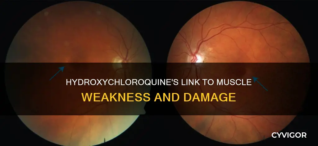 does hydroxychloroquine cause muscle weakness