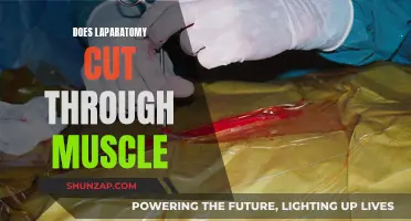 Laparatomy: Cutting Through Muscle for Surgery and Recovery
