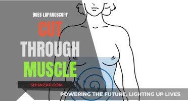 Laparoscopy: Cutting Through Muscle or Not?