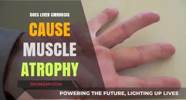 Liver Cirrhosis: Muscle Atrophy's Unseen Connection