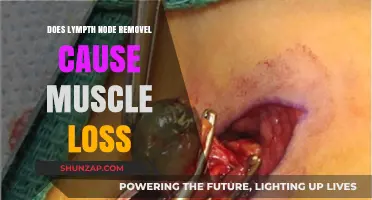 Lymph Node Removal: Does It Cause Muscle Loss?