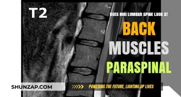 Exploring MRI Lumbar Spine: Do Back Muscles and Paraspinals Get Checked?