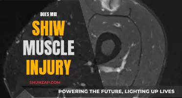 MRI Muscle Injury: What Does It Show?