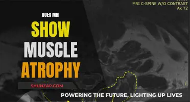 MRI Muscle Atrophy Detection: What You Need to Know