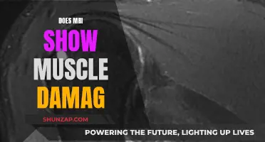 MRI Muscle Damage: What Does It Show?