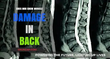 Unveiling the Truth: Can MRI Detect Muscle Damage in Your Back?