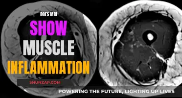 MRI Muscle Inflammation: What Does It Show?
