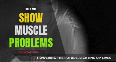 MRI Scans: Muscle Problems and What They Show