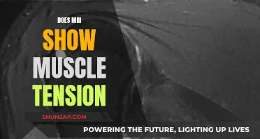 MRI Muscle Tension: What Does It Show?