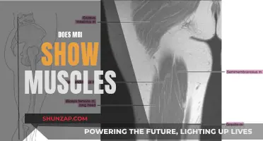 MRI Scans: Muscle Visibility and What They Show