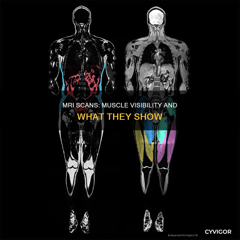 does mri show muscles