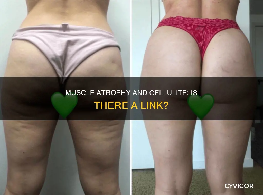 does muscle atrophy cause cellulite