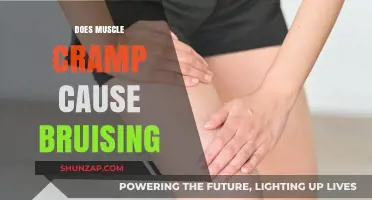 Muscle Cramps: Can They Cause Bruising?