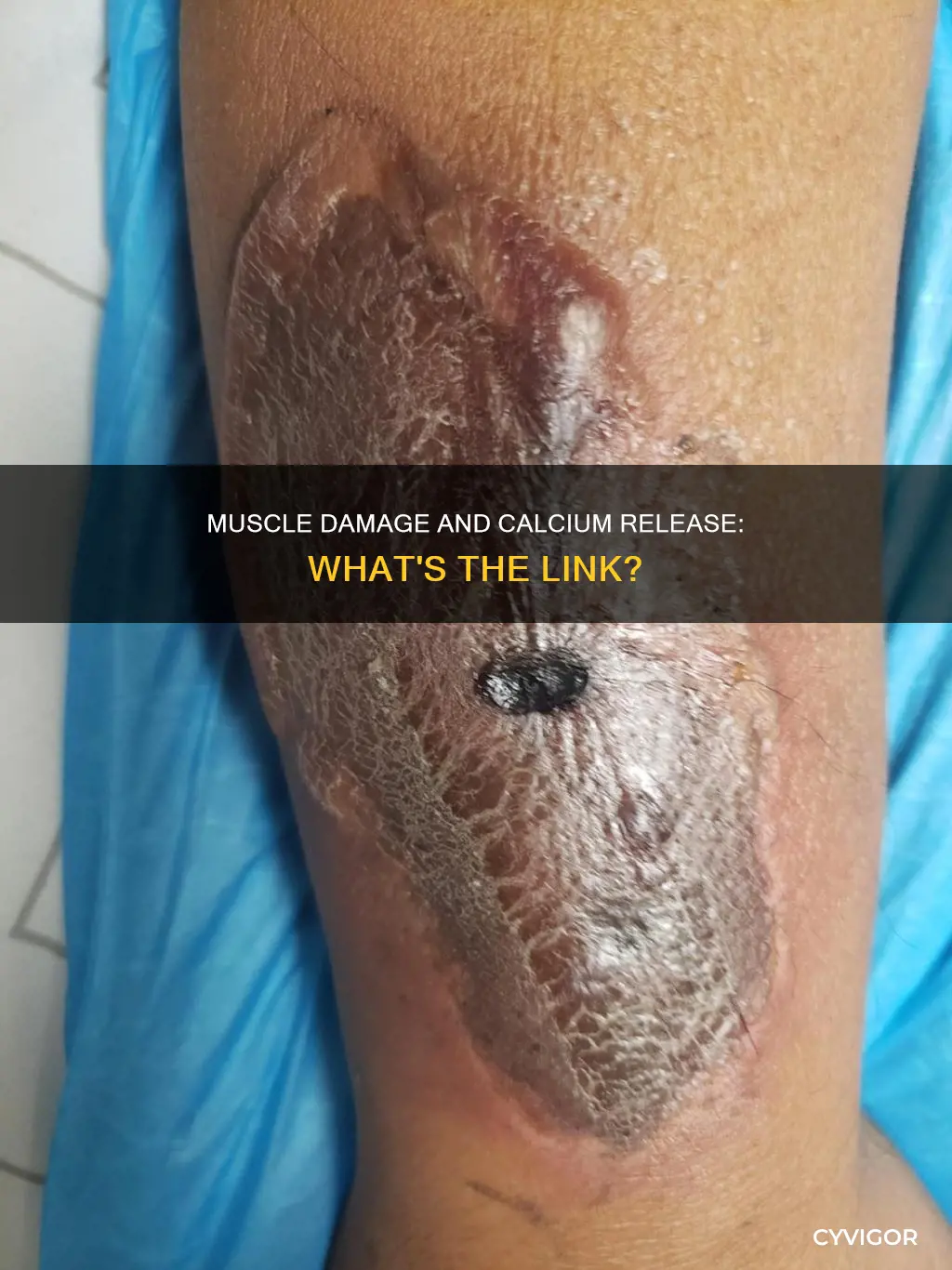 does muscle damage cause calcium release