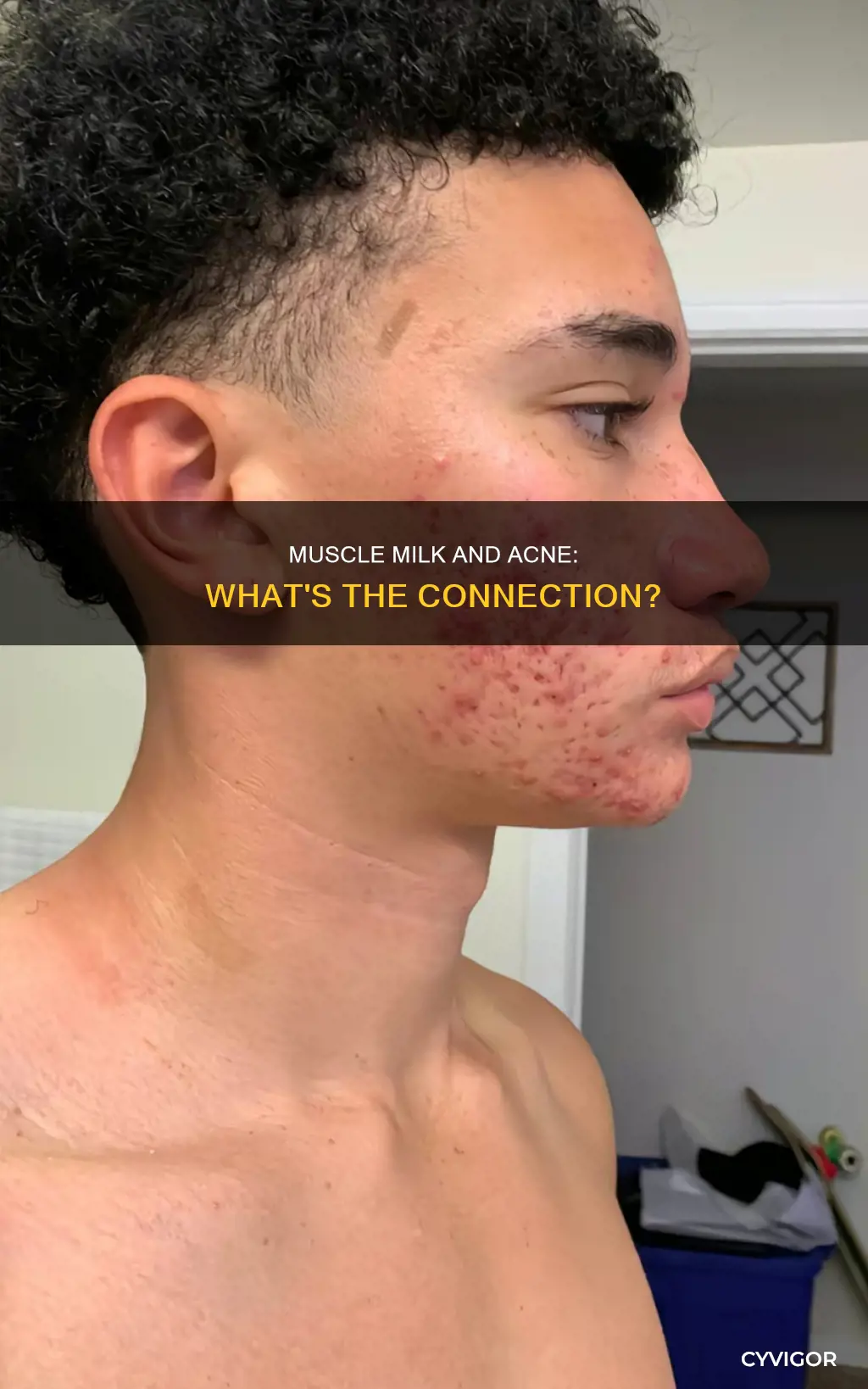 does muscle milk cause acne
