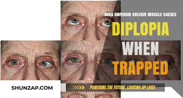 Oblique Muscle Trap: A Cause of Double Vision?