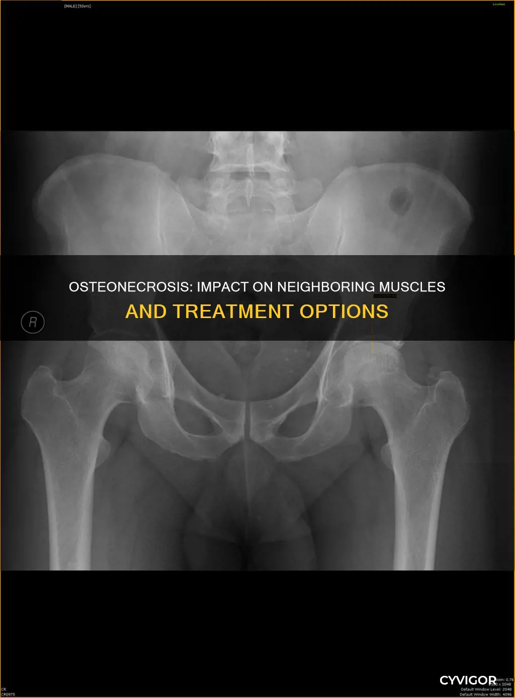 does osteonecrosis afffect surrounding muscles