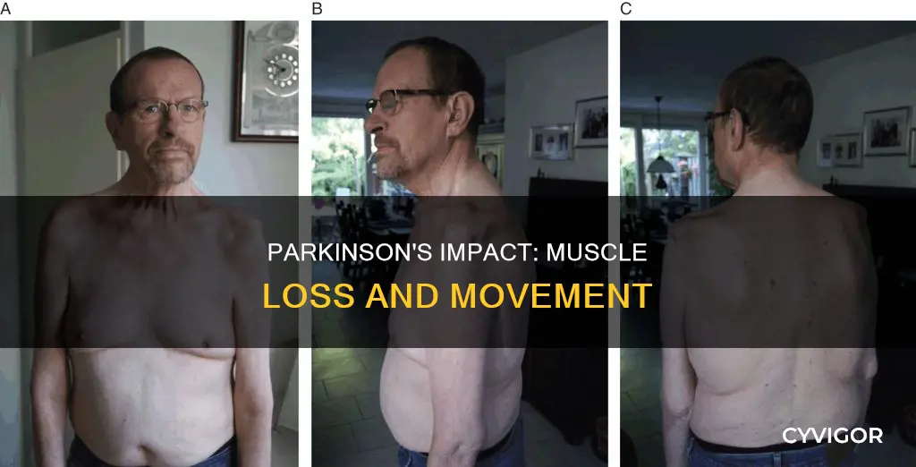 does parkinson