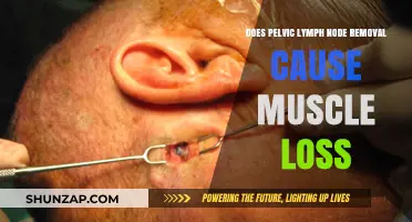Pelvic Lymph Node Removal: Does It Cause Muscle Loss?