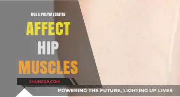 Exploring Polymyositis: Impact on Hip Muscles and Beyond