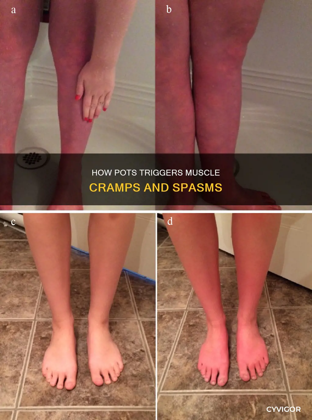 does pots cause muscle cramps