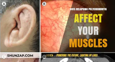 Exploring the Impact of Relapsing Polychondritis on Muscle Health