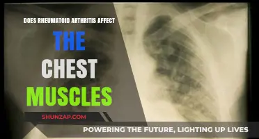 Exploring Rheumatoid Arthritis: Impact on Chest Muscles and Beyond