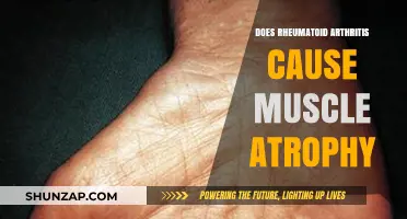 Rheumatoid Arthritis: Muscle Atrophy and You