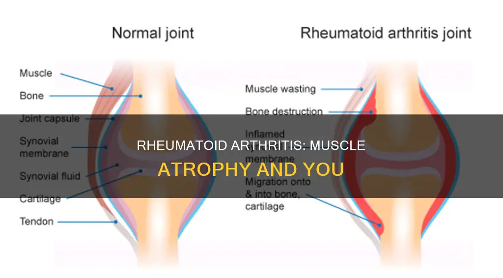 does rheumatoid arthritis cause muscle atrophy